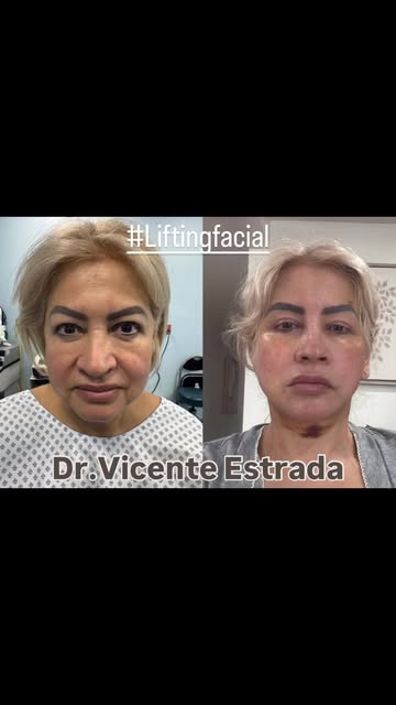 Lifting facial | Antes y después
Rejuvenecimiento facial buscando un resultado natural y armónico.

