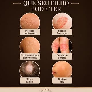Você conhece essas doenças de pele comuns na infância?

🔹 Molusco contagioso
Pequenas bolinhas caus