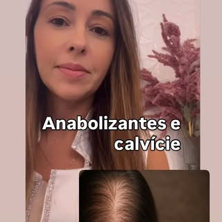 ANABOLIZANTES E ALOPECIA ANDROGENÉTICA: A CONTA CHEGA PARA O CABELO

Nem todo efeito colateral apare