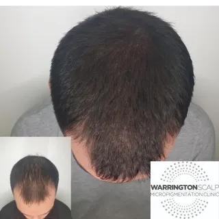 Not looking for a shaved head? Creating density can be the way forward...This is after two sessions 