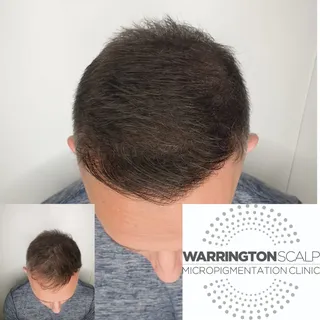 Not looking for a shaved head? Creating density can be the way forward...This is after two sessions 
