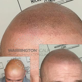 Great result after 3rd session!!

Huge transformation for this client.
Don't waste a single moment l