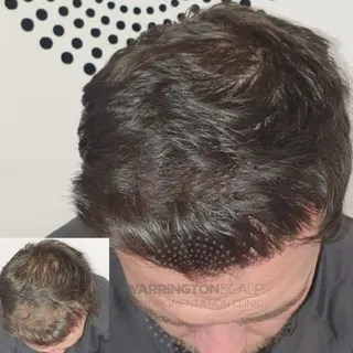 Not looking for a shaved head? Creating density can be the way forward...🔥 

Loads of experience ✅
