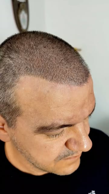 Você sofre com a calvície?
Preenchimento da calvície com resultado imediato e sem a necessidade de c