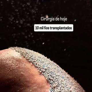 Cirurgia de transplante capilar FUE com 10 horas de duração e 10 mil fios transplantados. Grande esf