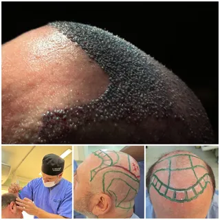 Alopecia Androgenética Grau 7 com 10 mil fios transplantados.
