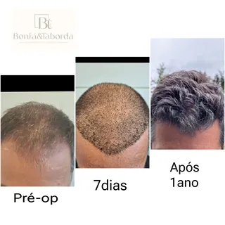 O resultado de um transplante capilar nunca é imediato. Após 30 dias do transplante, os fios novos t