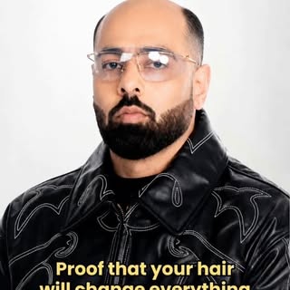 Proof that hair changes everything #chhattisgarh #hairtransplant #HairLossIndia #celebrity #hairloss