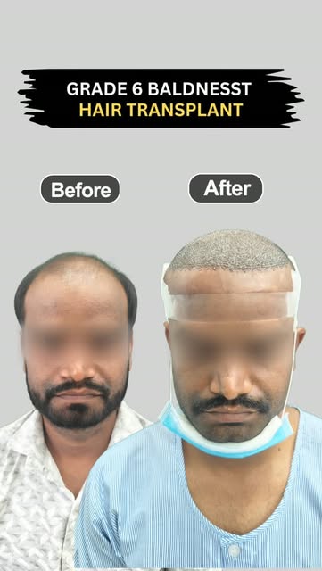 Another successful Hair Transplant journey at Dr. Majumdar's MD. Natural results, expert care, and a