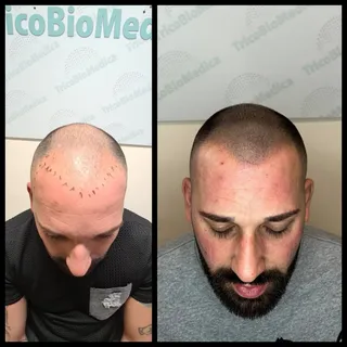 ☀️ Infoltimento e ricreazione bulbi piliferi su #Capelli rasati diradati grazie alla #Tricopigmentaz