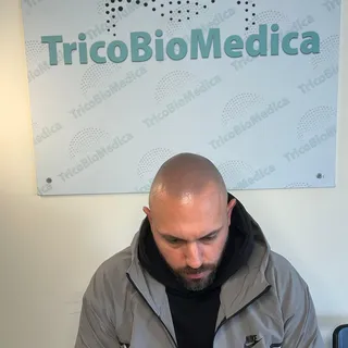 Tricopigmentazione effetto rasato 

Tecnica avanzata che ricrea l’aspetto del capello rasato in modo