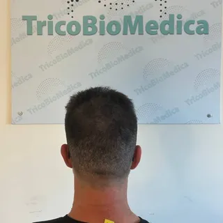 Tricopigmentazione effetto densità