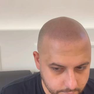 Tricopigmentazione effetto capelli rasati, seduta di mantenimento per maggiori info Whatsapp 3513611