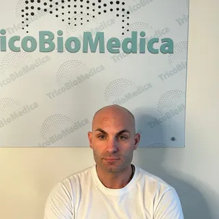 Tricopigmentazione effetto rasato