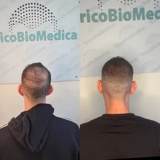 Tricopigmentazione effetto densità