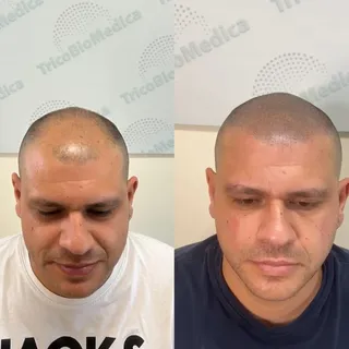 La tricopigmentazione effetto capelli rasati è una soluzione innovativa e altamente realistica pensa