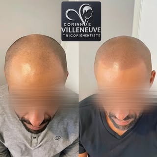 Reconstruction complète de la ligne frontale avec un effet rasé ultra naturel 

✔️ Création d’une li