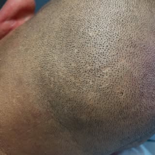 Correction esthétique post-FUE grâce à la tricopigmentation.
N’hésitez pas à me contacter 
www.corin