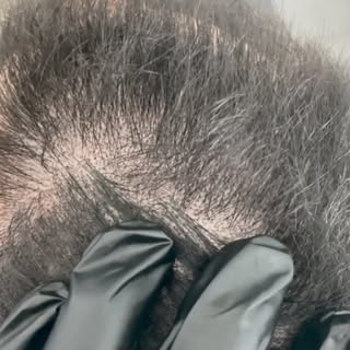 La tricopigmentation permet de camoufler les zones clairsemées, de restructurer visuellement la chev