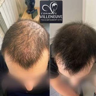 Effet de densité en tricopigmentation 

Objectif : redonner visuellement plus de densité aux cheveux