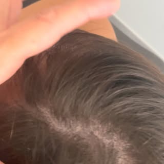 Voici le résultat final de la tricopigmentation de Mélissa après cicatrisation.

L’objectif était d’