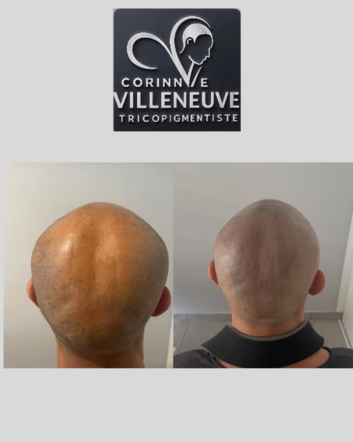Un effet rasé naturel, précis et parfaitement fondu.

La tricopigmentation, jusque dans les détails.