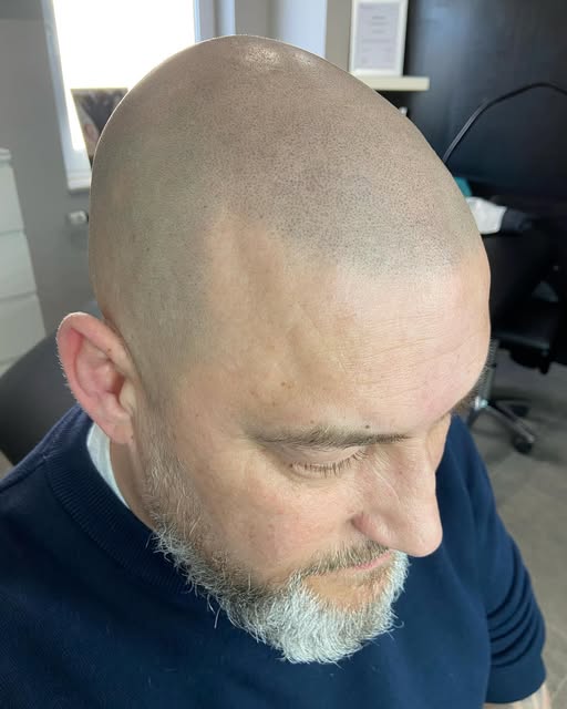 #smp #healed #cicatrisé #effetrasétricopigmentation 

Avant/Apres 3 séances cicatrisées après 6 sema