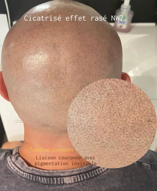Effet rasé naturel 
Liaison invisible de la couronne 💎 
Cicatrisé 3 séances . 
Dans 3 mois vérifica