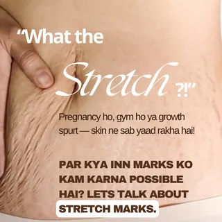 "What the Stretch?!"

Stretch marks aren’t just a “blemish”—they’re your skin’s way of adapting to g