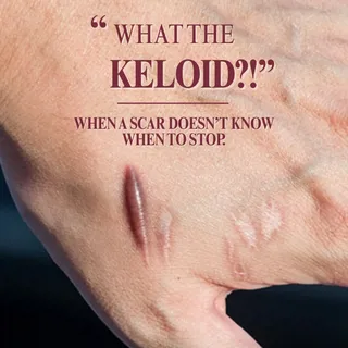 What the Keloid?!

When the scar doesn’t know when to stop.

Keloids are not normal scars.
They are 