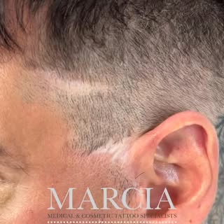 Amazing Results! 
Scar Camouflage using SMP. 
Now you see it now you don’t! 
SMP involves the implan