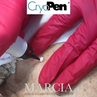 🤍 Sun Spot / Age Spot Removal‼️
🩶 Say goodbye to unwanted skin lesions with advanced CryoPen skin 