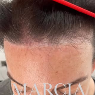 🩶 Scar Camouflage ‼️
🤍 Do you have a scar that you are conscious about? 
🩶 Scar Camouflage and Me