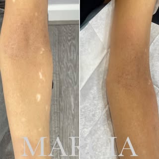 🩶 Medical Micropigmentation Skin Camouflage
🤍 Do you have a scar or an area of your skin that coul