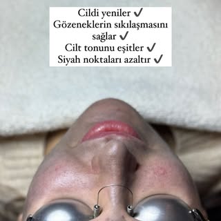 Sevgili diyetisyenimiz Hülya Hanım’a karbon peeling uygulamamızı gerçekleştirdik. ✨ @diyetisyenhulya