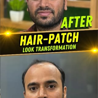Wow that’ was amazing look 😮✅ 
Hair replacement by 
@best_hair_patch 
@mahaveer_hair_solution_ .
.
