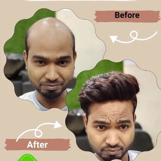 Wait for end ……..👨🏻‍🦲👉🏻👱🏻‍♂️

@best_hair_patch @mahaveer_hair_solution_ 
.
.
.
.
#hairsolutio