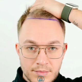 Doğal görünen bir saç çizgisi, doğru planlama ve deneyimli bir ekibin çalışmasının sonucudur.

Back 