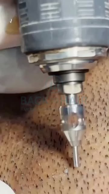 Doğal ve başarılı sonuç, doğru ekiple başlar. 

Saç ekiminde en önemli aşamalardan biri olan kök alı
