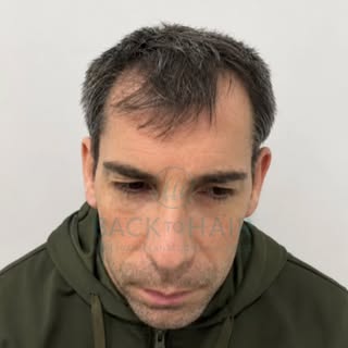 1 Yıl Sonra: Sık, doğal ve güçlü bir sonuç. 

Öncesi, ekim sonrası ve 1 yıl sonraki güncel sonuç…
Ön