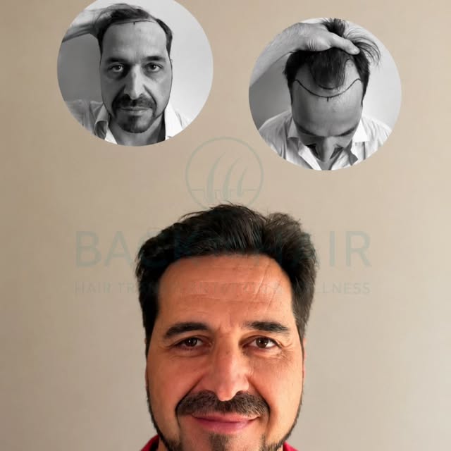 Danışanımızın saç ekimi sürecini Back to Hair olarak başından sonuna kadar titizlikle planladık ve y