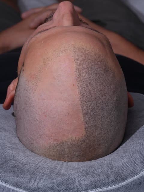 Si, ho eseguito il trattamento in una sola seduta.
A dire la verità negli ultimi mesi ho deciso di e
