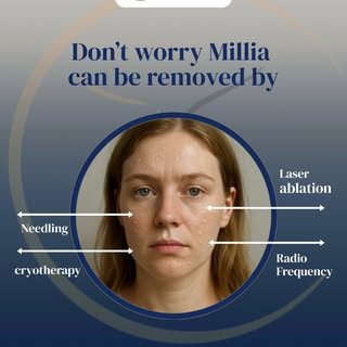 ✨ Say goodbye to Milia, safely and effectively! ✨
At Skin & Recon Dermatology and Plastic Surgery Cl