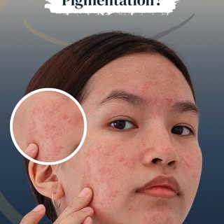 Say goodbye to stubborn pigmentation.
 ✨ At Skin & Recon, we bring advanced treatments that restore 