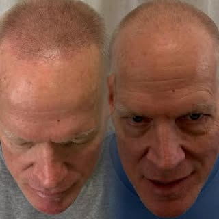 Is SMP Right for You? 🤔

Struggling with thinning hair, bald spots, or receding hairlines? Scalp Mi