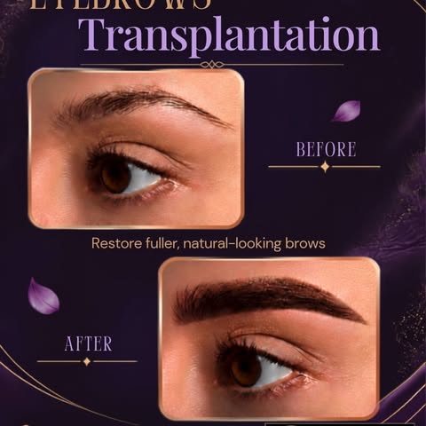 Thin or missing eyebrows can happen for many reasons — including over-plucking, shaving, burns, or s