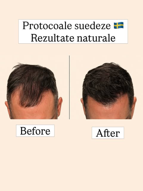 Vârstă: 44 ani
Caz: Norwood III
Zona principală: frontală + tâmple
Obiectiv: refacerea liniei fronta