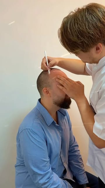 Natural results in progress… ⏳ #hairtransplant #naturalresults