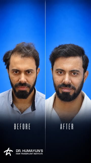 A transformation worth watching. ✨

Take a look at Amir Sohail’s hair restoration journey, captured 