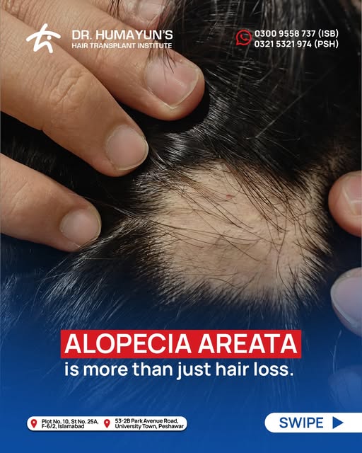 Alopecia Areata can appear suddenly, but recognizing the signs early can make a difference.

From un